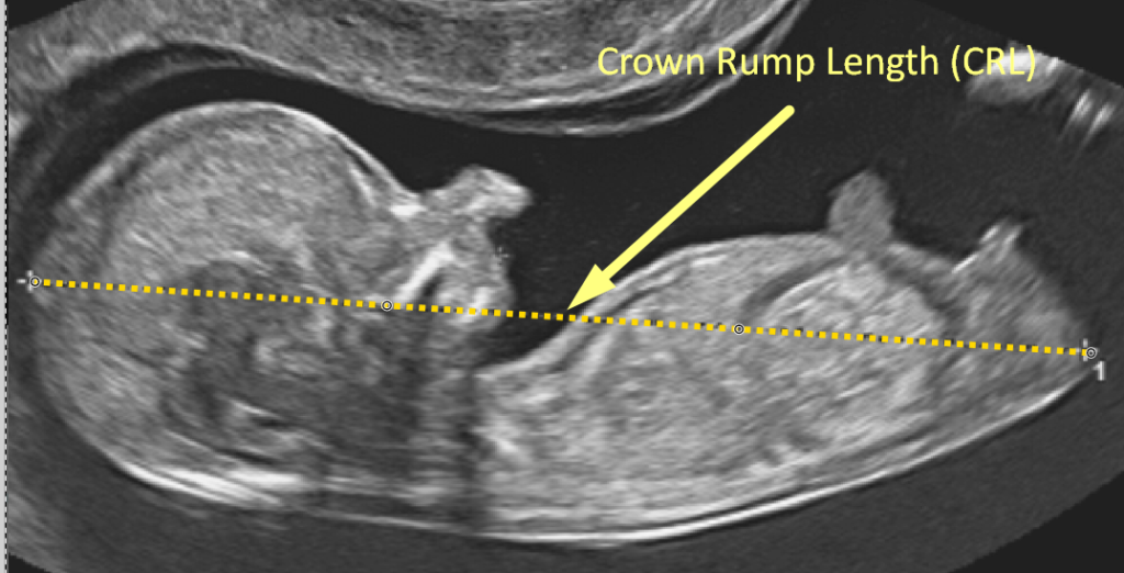 Crown Rump Length - CRL Ultrasound